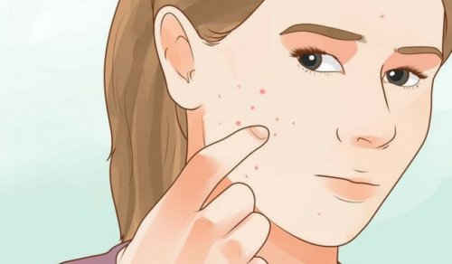 A acne é um dos sintomas de desequilíbrio hormonal