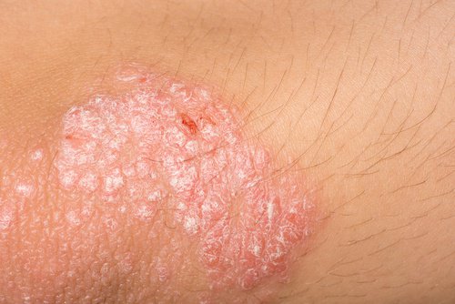 As doenças cutâneas podem estar relacionadas ao intestino