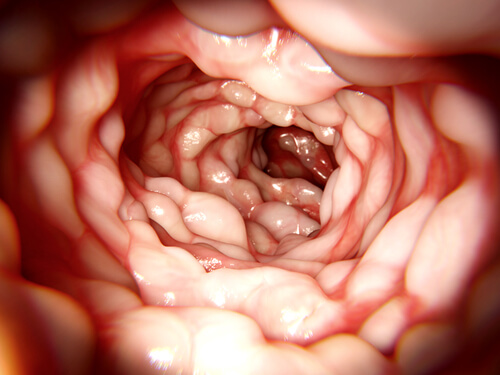 Endoscopia em paciente com Doença de Crohn