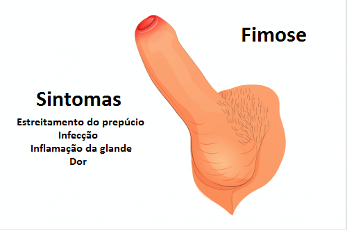 Saiba mais sobre a fimose