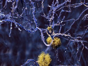 Tipos de demência que não são Alzheimer
