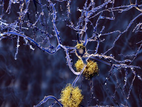 Tipos de demência que não são Alzheimer