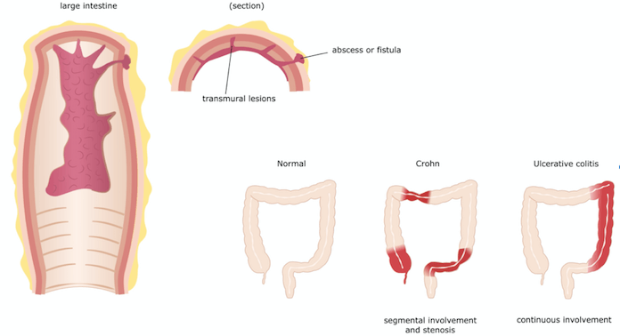 Anatomia da Doença de Crohn