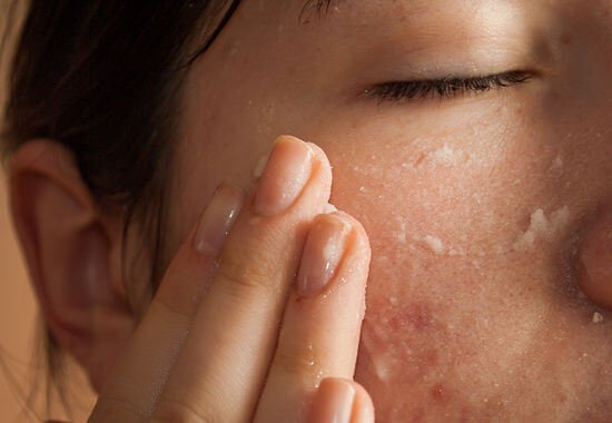 Máscaras com bicarbonato de sódio contra a acne