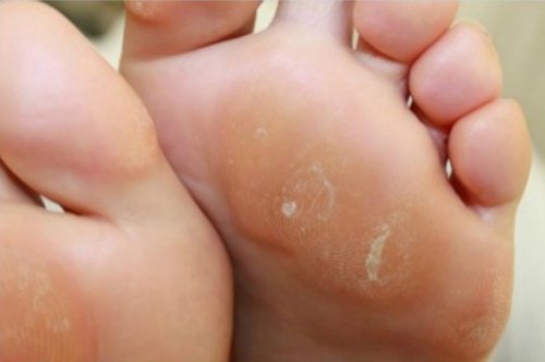 Melhor remédio para os calos dos pés: cebola e vinagre branco