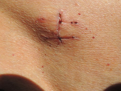Cicatriz de cirurgia de hérnia inguinal