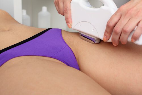 Depilação laser