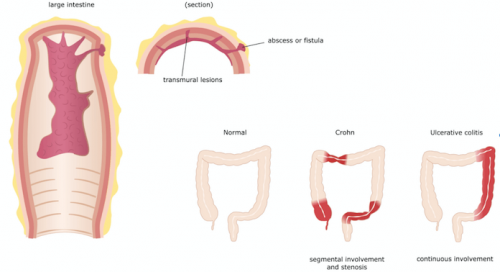 Intestinos em pacientes com Doença de Crohn