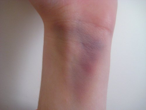 Hematoma no pulso: pode tratar com casca de banana