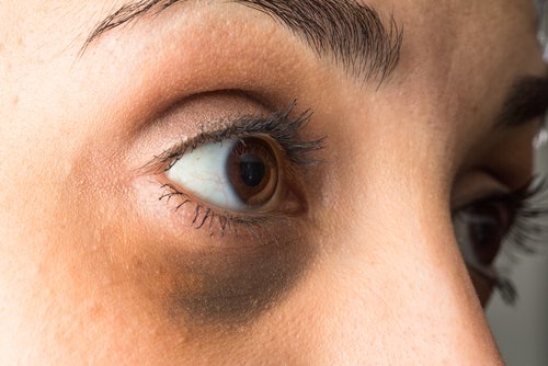 As olheiras podem ser sintomas de desequilíbrio hormonal