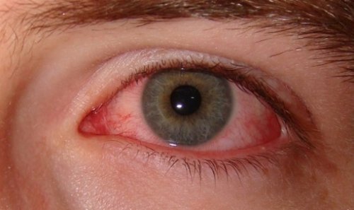 Olho vermelho pela Síndrome do Olho Seco