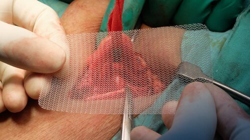 Cirurgia da hérnia inguinal