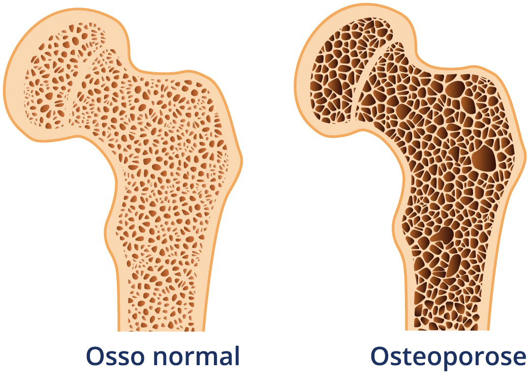 Osteoporose relacionada à Doença de Crohn