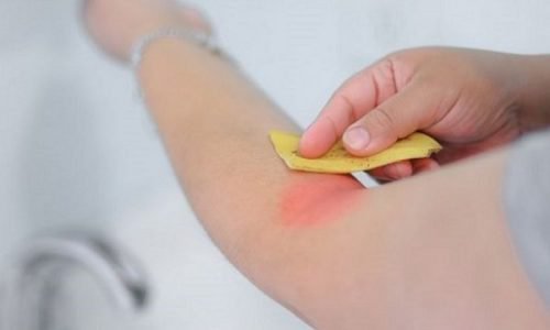 Casca de banana para aliviar picadas de inseto