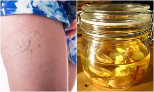 Como preparar uma pomada caseira para evitar as microvarizes