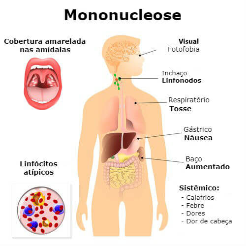 Sintomas da mononucleose infecciosa