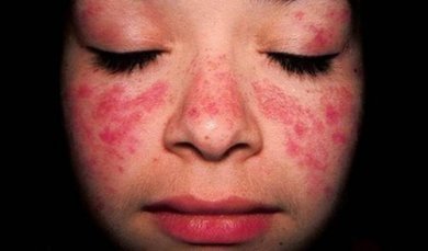 Tratamento do Lúpus Eritematoso Sistêmico (LES)