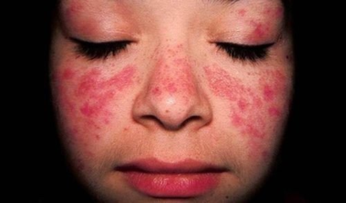 Tratamento do Lúpus Eritematoso Sistêmico (LES)