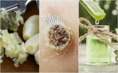 5 remédios naturais para eliminar as verrugas