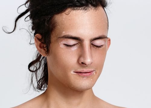 Rosto com vitiligo