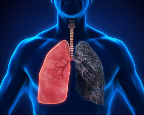 8 sintomas da pneumonia que você não pode ignorar 8 sintomas da pneumonia que você não pode ignorar