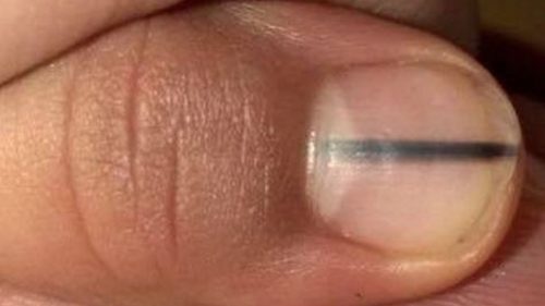 Uma linha negra nas unhas pode ser um sinal de câncer, sabia? Uma linha negra nas unhas pode ser um sinal de câncer, sabia?