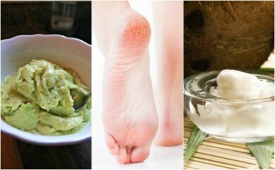 Remédios naturais para calcanhares rachados