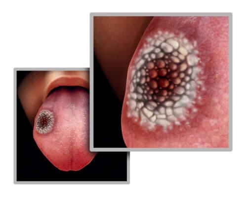 Os 5 possíveis primeiros sintomas do câncer de língua