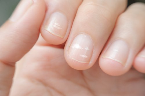 As linhas nas unhas podem indicar déficit de zinco