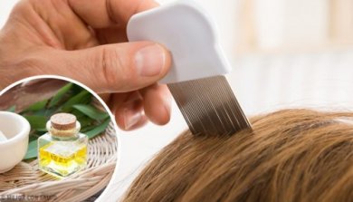 6 produtos caseiros que ajudam a eliminar os piolhos