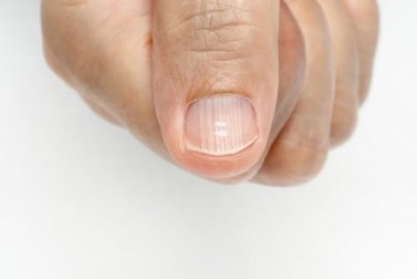 Por que tenho linhas nas unhas e como eliminá-las?