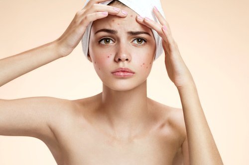 Mulher com acne