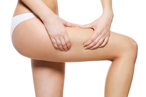 Mulher com celulite nas pernas