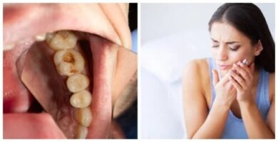 Infecção dentária: 7 sintomas de alerta