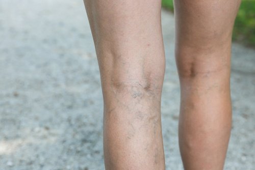 Pernas com veias varicosas