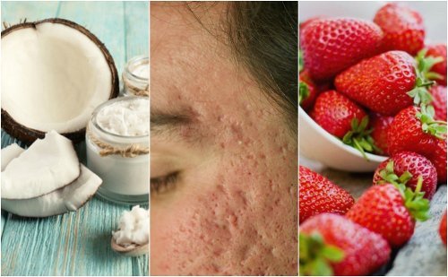 Como atenuar cicatrizes de acne com 5 tratamentos caseiros