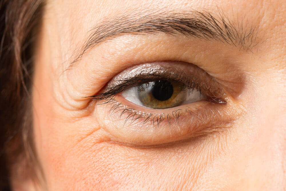 Olhos com bolsas e olheiras