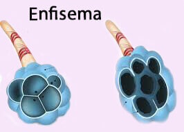 Enfisema