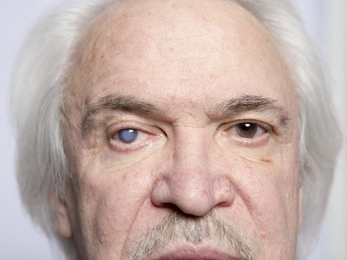 Cataratas no olho direito