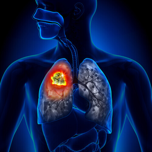 Imagem de câncer de pulmão