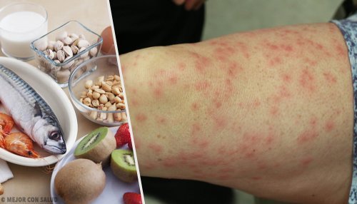 Conheça os alimentos alergênicos mais comuns e seus melhores substitutos