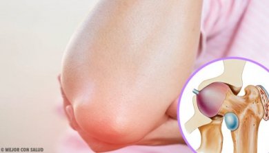 Tudo o que você deveria saber sobre a bursite