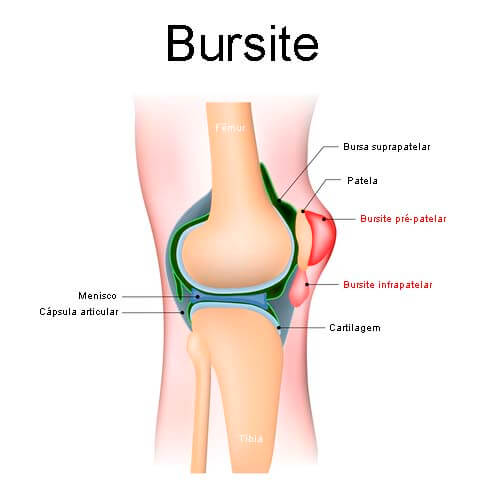Imagem de bursite