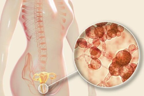As causas, sintomas e tratamento da candidíase vaginal