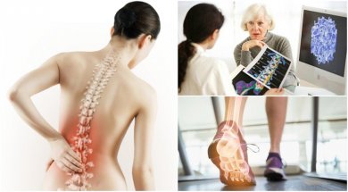 6 fatos sobre a osteoporose que é importante conhecer