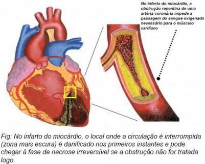 Infarto Agudo Do Mioc rdio O Que Voc Sabe Sobre Ele 