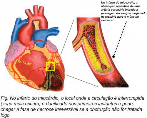 Infarto agudo do miocárdio