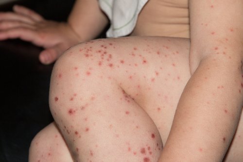 Vírus de Coxsackie: como afeta adultos e crianças e como se proteger dele?