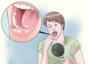 8 remédios naturais para as úlceras na boca