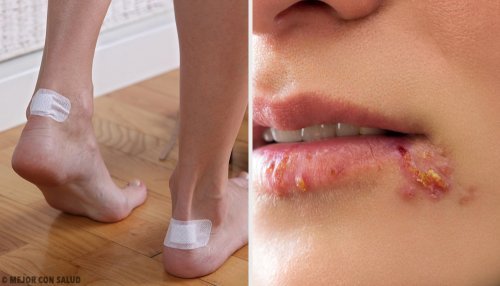 5 soluções para acabar com bolhas e obter uma cura eficaz
